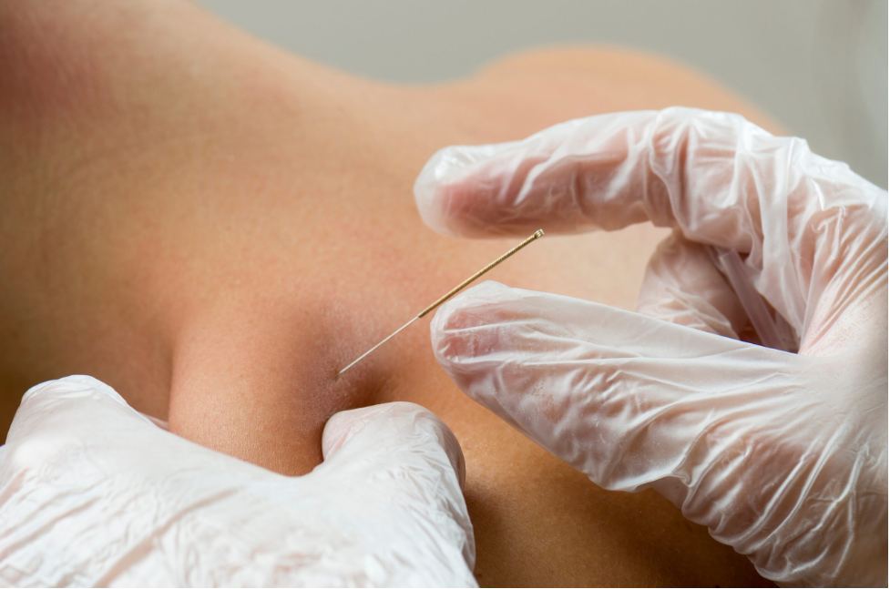 Dry Needling Image